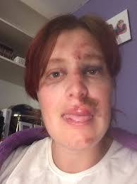 We've suffered major injuries in the last three years😭