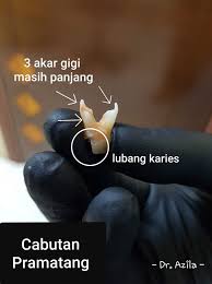 Cabut gigi geraham diperlukan jika kondisi gigi sudah rusak parah. 3 Hari Tanggung Derita Sakit Gigi Sampai Bengkak Muka The Reporter