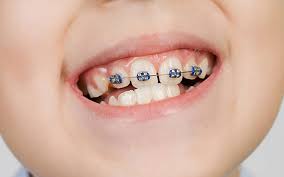 They consist of small metal brackets which are fitted to the front of your teeth with a wire running between them kept in place by small elastic bands. Types Of Braces Specialist Orthodontist In Mackay Torque Orthodontics