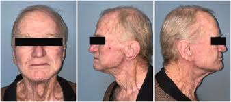 The deep plane face and neck lift to treat post-radiation lymphedema