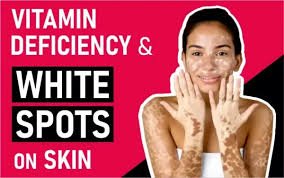 Image result for Vitamin Deficiency