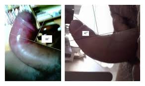 It is also called fibrous histiocytoma, histiocytoma or sclerosing hemangioma. Androtherm Application For The Peyronie S Disease