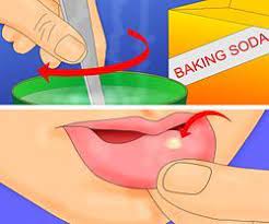 How To Remove A Mouth Ulcer Heal Canker Sore Mouth Ulcers Mouth Sores