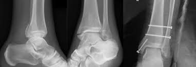 We did not find results for: Caso Clinico Fractura De Maisonneuve Tibia Y Perone Fase I Rehabilitacion Premium Madrid