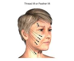 شدّالوجه و الرقبة و أعلى الصدر...... إزالة التجاعيد و الترهّل من الوجه و  الرقبة ....... إعادة النضارة و الشبابية ,بدون جراحة و بتقنيّة الشدّ بالخيوط  الإيطالية الحديثة المخفيّة تحت الجلد و المبتكرة ,,