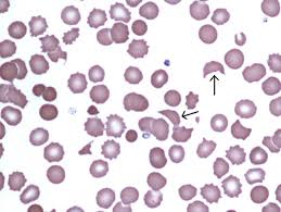 Image result for Penicillin Resistant Pneumococcus
