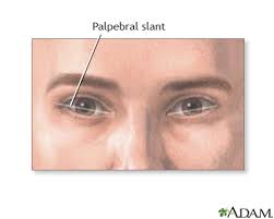 Palpebral Slant Eye Information Mount Sinai New York