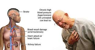 Image result for atherosclerosis signs and symptoms