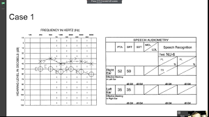 The graph to the left represents a blank audiogram illustrates the degrees of hearing loss listed above. Speech Audiometry Practice Youtube