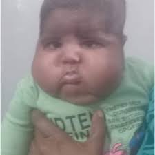 PDF) BETAMETHASONE cream to treat diapers rash causing Cushing syndrome