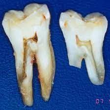 Ursachen Fur Langsfrakturen Endodontie Dr Eggert