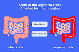 Image result for Diverticulitis