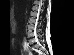 An mri is a test that uses a magnetic field and pulses of radio wave energy to. Back Pain And Normal Mri Is It Possible Advanced Pain Management Center Interventional Pain Management Physician