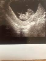 Ab wann ist das geschlecht eines babys erkennbar? Kann Man Hier Das Geschlecht Erkennen Nub Forum Madchen Oder Junge Urbia De