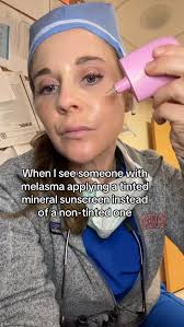 Melasma can present as brown spots