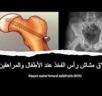‫SCFE / انزلاق مشاش رأس الفخذ عند الأطفال والمراهقين‬‎