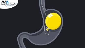 بالون المعدة ماجيك استاتيك لعمليات التجميل