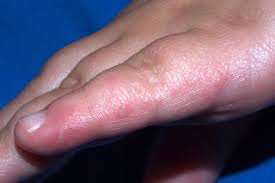 It is very contagious and most common in children under 5 years old. Hand Foot And Mouth Disease Nhs