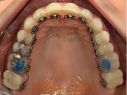 While water flossers are a fantastic part of the flossing routine, dr. Lingual Braces Cooper Orthodontics Proudly Serving Houston