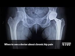 Painful lump on hip symptoms explained painful hip lump causes how and when to treat a painful hip lump faqs about painful hip lump painful hip this process begins before birth, and the cause of the gene mutation is not fully known. When To See A Doctor About Chronic Hip Pain Youtube