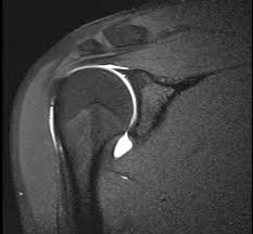 Mri is the modality of choice for assessment of hagl, especially as the finding may be difficult to diagnose on arthroscopy. Humeral Avulsion Glenohumeral Ligament Hagl Shoulder Elbow Orthobullets