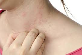 Pentru reducerea riscului de impetigo, copilul va evita contactul cu persoanele care sufera de aceasta afectiune. Ce AfecÈiuni AnunÈÄ InroÈirea Pielii Èi MancÄrimile DupÄ Expunerea La Soare