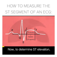 Image result for ST Elevation