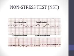 A nonstress test (nst) is a screening test used in pregnancy to assess fetal status by means of the fetal heart rate and its responsiveness. How To Read Nst Graph