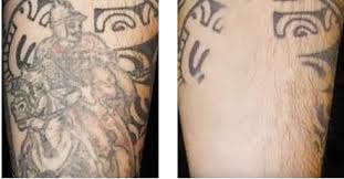 We researched it for you: Top Laser Tattoo Removal Center In San Antonio Boerne