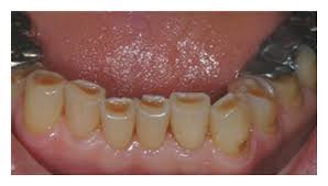 Image result for Tooth Attrition