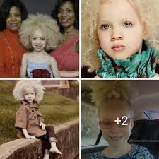 Beautiful Ava Clarke Both Of Her Parents Are Black She Has Albinism Black And Blonde White Blonde Hair Black Is Beautiful