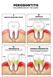 One and the same issue. Orchid Periodontics And Dental Implants Periodontal Procedures In Edmonds