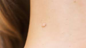 Image result for Skin Tag