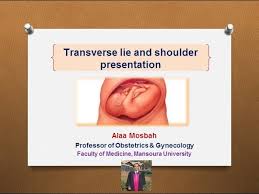Image result for Shoulder Presentation
