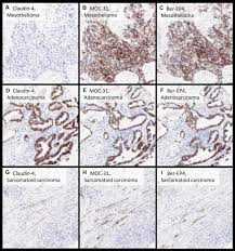Our free guide includes information on legal compensation, treatment options, and more. Claudin 4 Shows Superior Specificity For Mesothelioma Vs Non Small Cell Lung Carcinoma Compared With Moc 31 And Ber Ep4 Sciencedirect