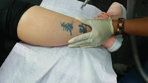 Spilus nevus, becker nevus, melasma, post inflammatory hyperpigmentation. Laser Tattoo Removal Home Facebook