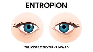 Image result for Entropion
