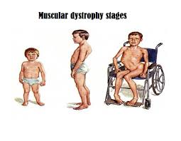 Image result for Μυϊκή Δυστροφία Ντουσέν