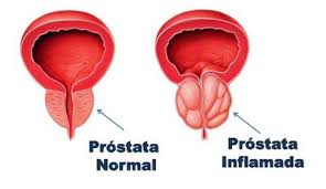 Resultado de imagen para imÃ¡genes de hombre con prÃ³stata sana