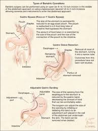 Please Visit Our Website At Www Drshillingford Com To Learn More About Bariatric Surgery Bariatric Bariatric Surgery Surgery