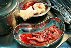 Orgullo Español on Twitter: "Esto es el aborto, un vil asesinato al humano  más débil. La imagen es dura pero es la cruda realidad.  http://t.co/ZhsTnkufA9"