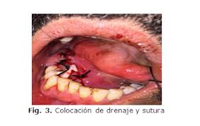 Image result for Sialoadenitis