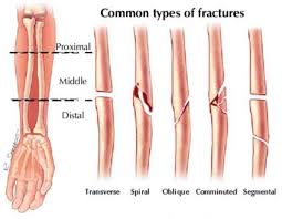 Sebenarnya, apa yang dimaksud dengan depresi? Fraktur Radius Ulna Docx Document