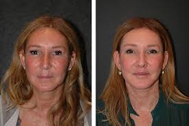 Prices include state taxes, installation and a one year. Mini Facelift Best Mini Facelift By Dr Andrew Jacono