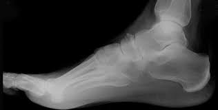 I can walk perfectly fine now. Navicular Dorsal Avulsion Fracture Ortho Teaching Files Nuem Blog