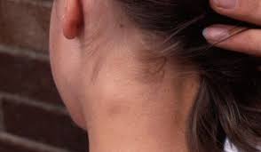 What Should You Do About Swollen Lymph Nodes Swollen Lymph Nodes Lymph Nodes Beauty Diet