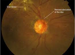 This means you may have had to wait longer than usual for your routine diabetic eye screening appointment. Diabetes Diabetic Retinopathy And The National Service Framework International Journal Of Ophthalmic Practice