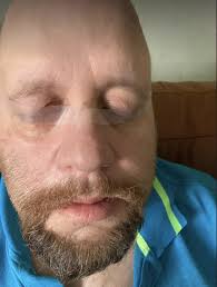 Scots newlywed left with 'eyes stuck wide open' as doctors fear rare form  of cancer