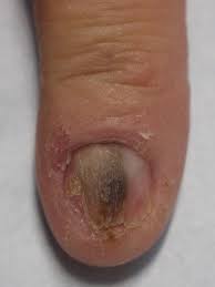 Image result for Onychotillomania feet