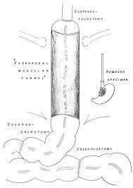 Colocolostomy definition at dictionary.com, a free online dictionary with pronunciation, synonyms and translation. A New Approach To The Palliation Of Advanced Proximal Gastric Cancer Sciencedirect